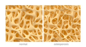Bad bones: Preventing and coping with Osteoporosis and Osteoarthritis 1